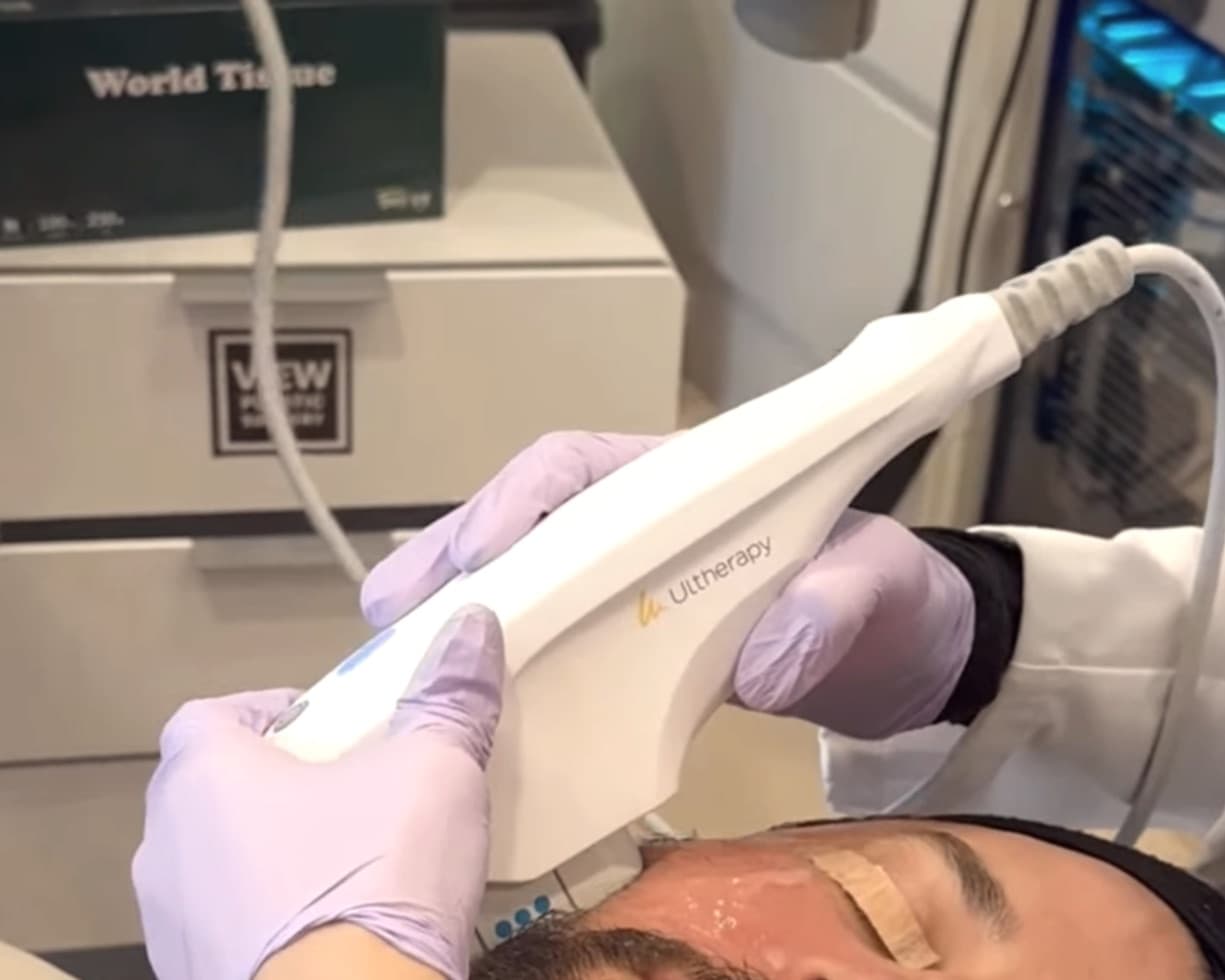 A clinician holding an Ultherapy handpiece against a patient's face.